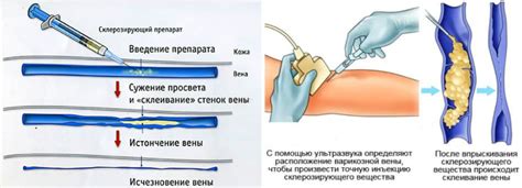 Компрессионная склеротерапия вен нижних конечностей