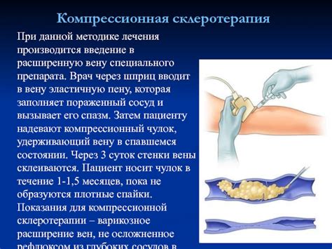 Компрессионная склеротерапия - методы комбинированного лечения